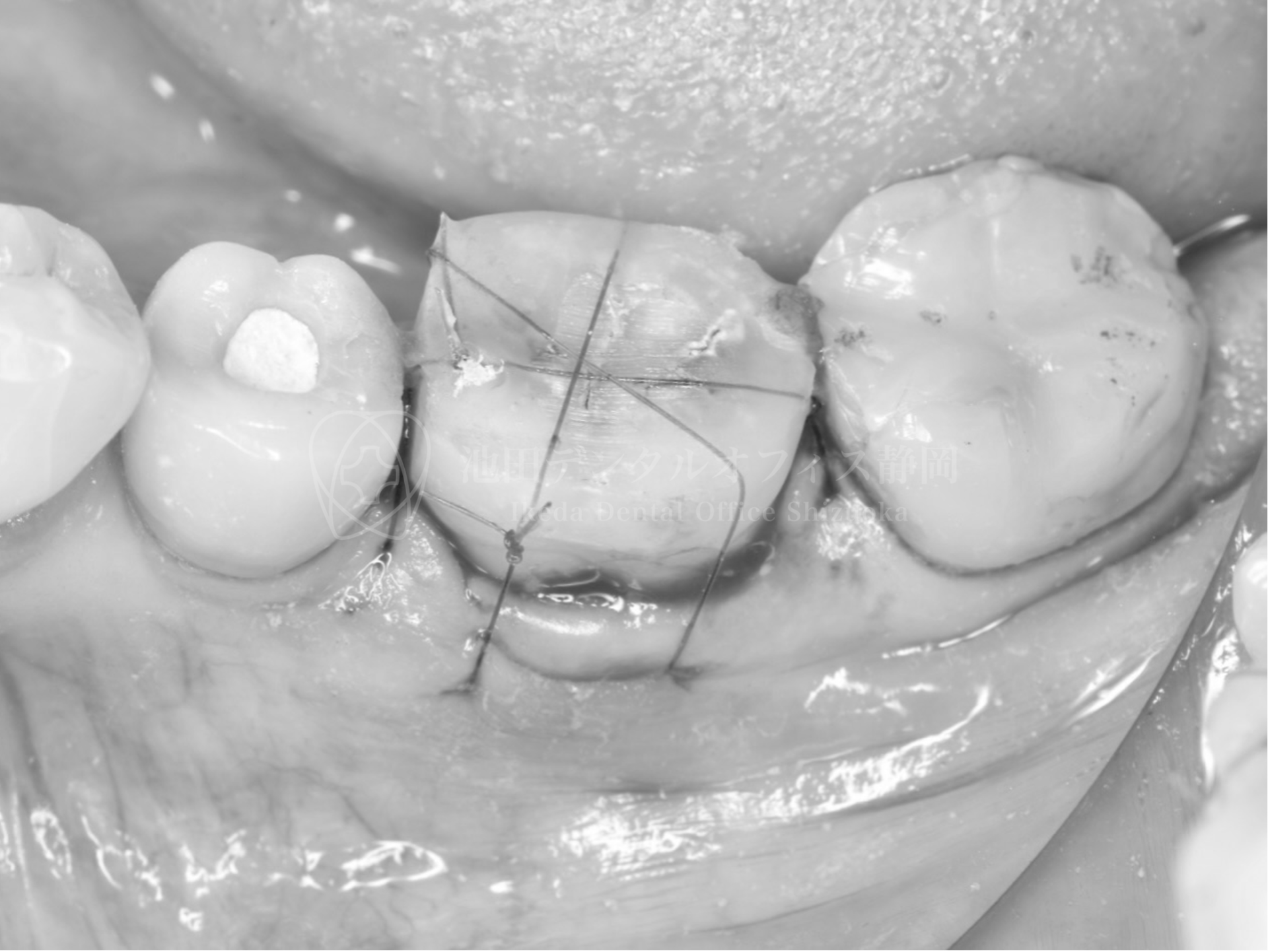 割れた歯に親知らずの移植で対応した症例（40代）｜池田デンタル